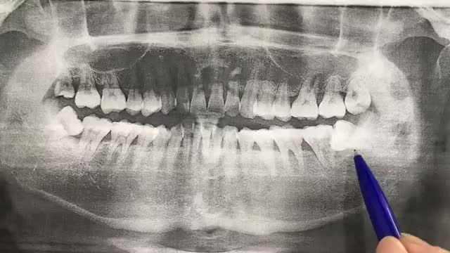 Ca nhổ răng số 37, 38 mọc lệch 90 độ gây sâu hỏng răng 37