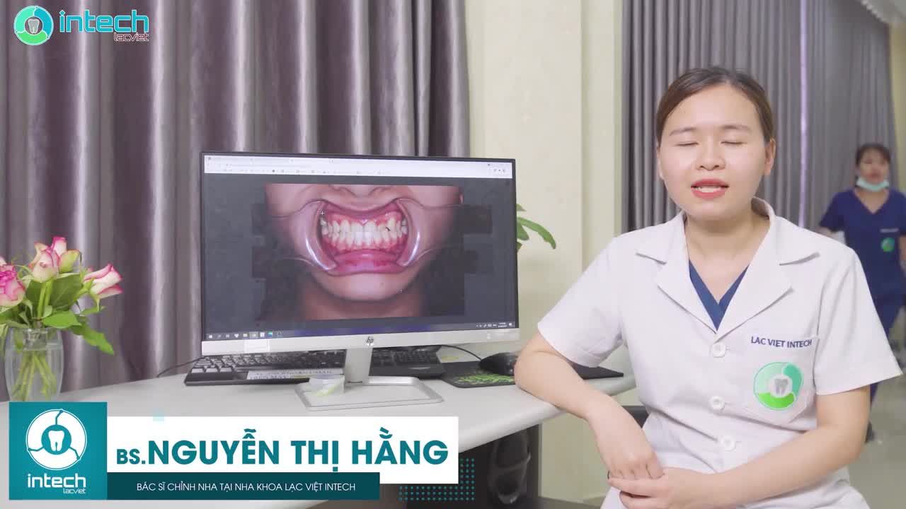 CA NIỀNG RĂNG MÓM THAY ĐỔI SAU 3 THÁNG ĐIỀU TRỊ