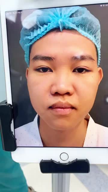 Ca phẫu thuật NÂNG MŨI CẢI THIỆN SỐNG THẤP
