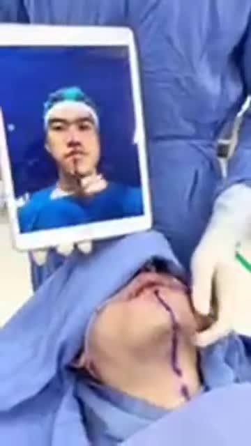 Ca phẫu thuật thành công - Chỉnh mặt lệch cực khó tại BVTM Kangnam