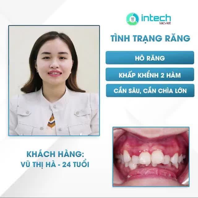 CẢM NHẬN SAU 11 THÁNG NIỀNG RĂNG TẠI LẠC VIỆT INTECH