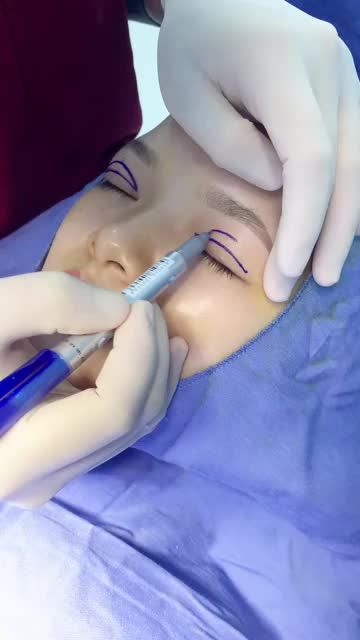Cận cảnh 1 ca CẮT MÍ PLASMA tại Kangnam