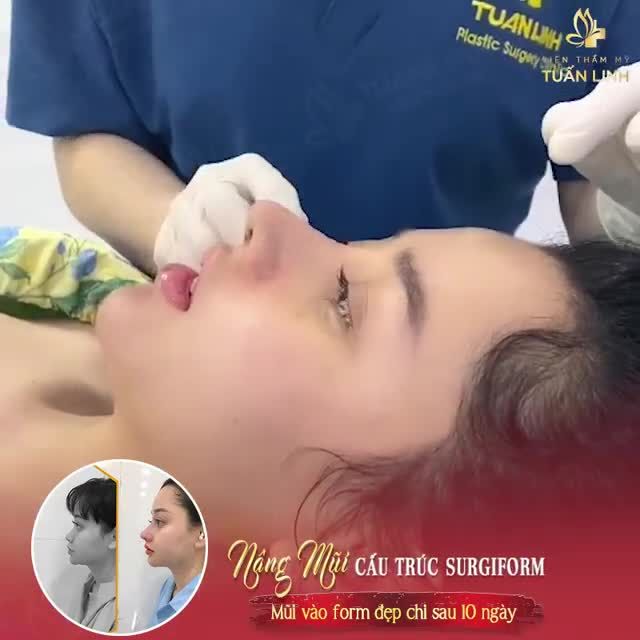 Cận cảnh dáng mũi cấu trúc Surgiform sau 10 ngày tháo nẹp