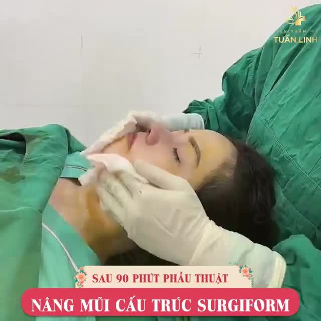 CẬN CẢNH DÁNG MŨI CẤU TRÚC SURGIFORM SAU 90 PHÚT PHẪU THUẬT.