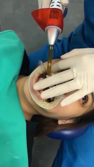 CẬN CẢNH GẮN MẮC CÀI CHO KH 2K TẠI VIỆN CHỈNH NHA SHINBI SỐ 3 TRẦN QUANG DIỆU