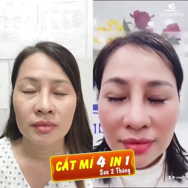 CẬN CẢNH HÌNH ẢNH KHÁCH HÀNG THỰC TẾ SAU 2 THÁNG CẮT MÍ 4 IN 1 BỞI BÁC SĨ PARK