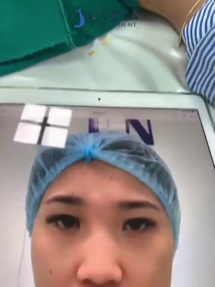 Cận cảnh kết quả ca nâng mũi bán cấu trúc + thu nền xương