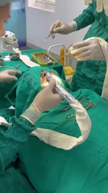 CẬN CẢNH QUÁ TRÌNH THỰC HIỆN TRỒNG RĂNG IMPLANT TRONG PHÒNG VÔ KHUẨN - XỬ LÝ CA MẤT RĂNG SỐ 7 TẠI VIỆN CẮM RĂNG IMPLANT SỐ 33 TRẦN QUỐC TOẢN