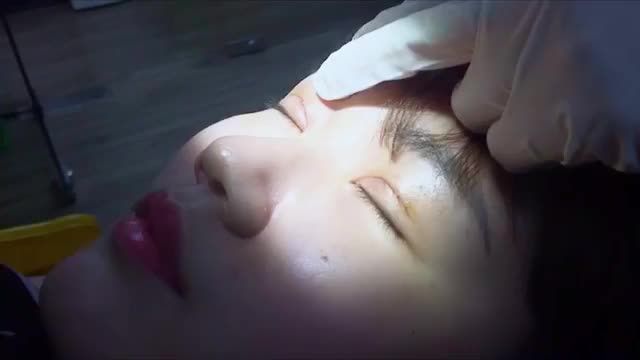 Cận cảnh quy trình cắt chỉ mí mắt sau 7 ngày Mời quý khách hàng cùng đón xem