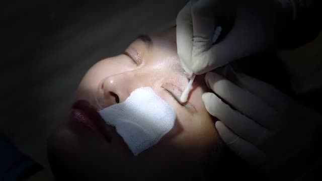 Cận cảnh quy trình cắt chỉ mí mắt sau sửa mí hỏng 7 ngày