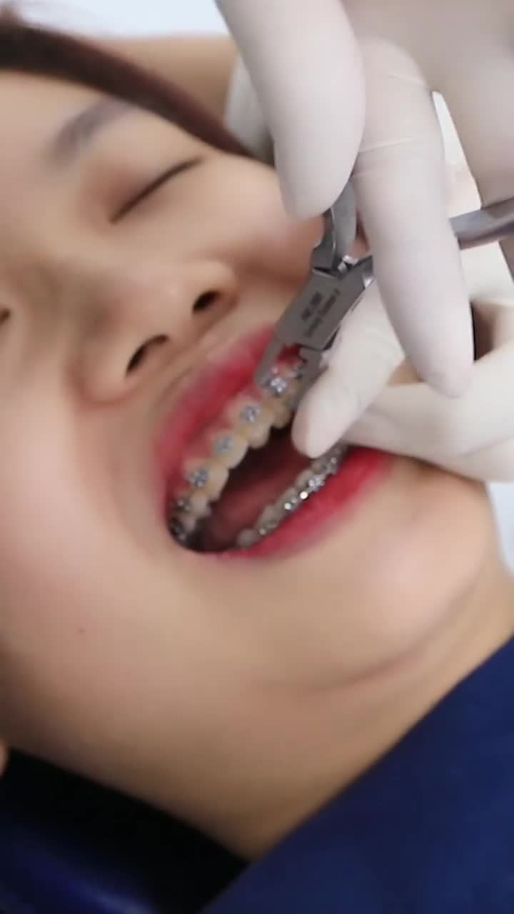 Cận cảnh tháo niềng răng mắc cài kim loại - Case 8465: Khách Hàng Quỳnh Anh