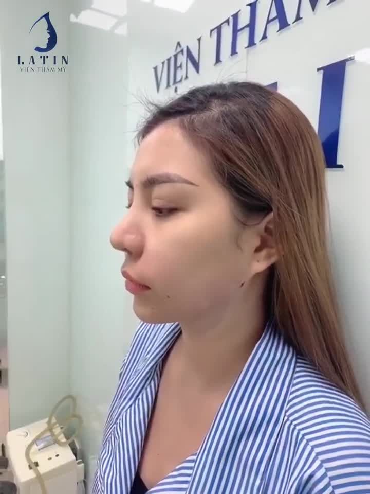 Case hút mỡ nọng cằm + cấy mỡ rãnh cười cho bạn gái chỉ sau 30 phút, giải quyết ngay các vấn đề: