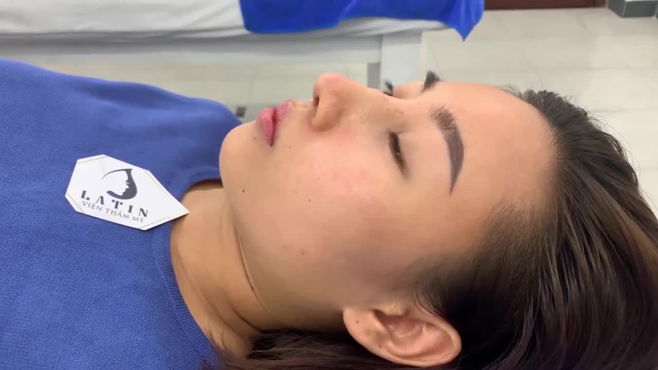 Case tái khám sau 1 tháng nâng dáng mũi Latin. Niềm hạnh phúc hiện rõ trên gương mặt của khách hàng khiến đội ngũ Latin​ cũng cảm thấy vui lây