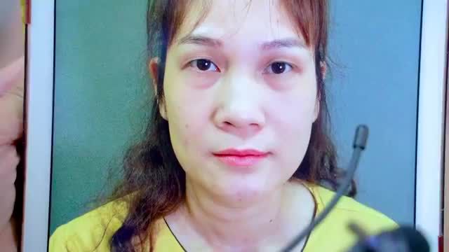 Cắt bọng mỡ mí dưới + Cắt tạo hình 2 mí trên vừa thực hiện xong mời quý khách hàng cùng chiêm ngưỡng