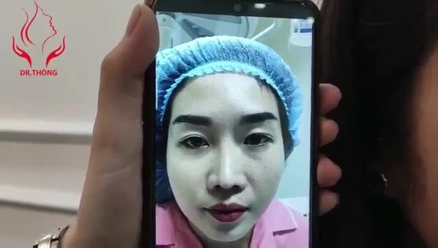 CẮT MÍ 2 LẦN ĐỀU HỎNG LẦN 3 SỬA LẠI TẠI DR.THÔNG SAU 8 THÁNG CỰC KỲ ƯNG Ý - ĐẸP NHƯ MỚI!!!