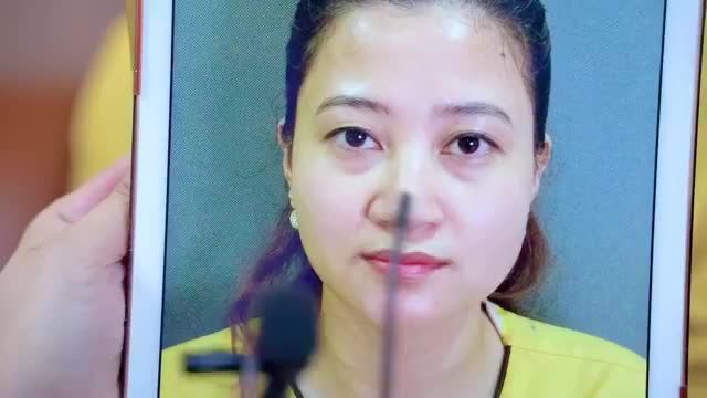 Cắt mí đẹp lại còn ít sưng, ít đau, bình phục nhanh Chỉ có thể nhờ tay nghề đội ngũ Bác sĩ tại Dr.Hải Lê