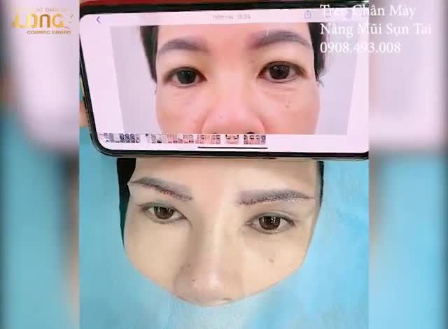 Cắt mí Nâng mũi quan trọng nhất là điều gì ???