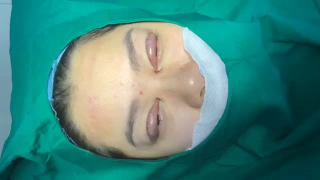 CẮT MÍ TOTAL MỞ KHOÉ GÓC MẮT TRONG