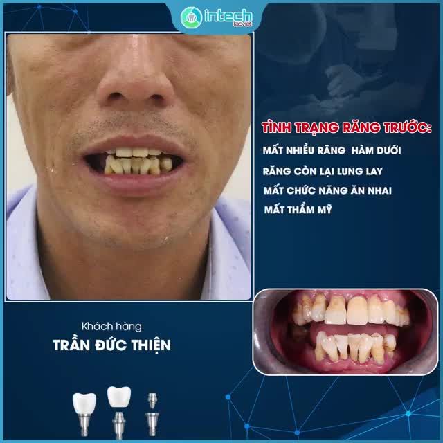 CẤY GHÉP IMPLANT - GIẢI PHÁP ĂN NHAI TRỌN VẸN