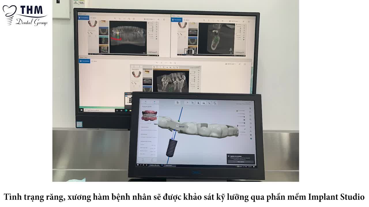 CẤY GHÉP IMPLANT R46 - SỬ DỤNG MÁNG HƯỚNG DẪN PHẪU THUẬT
