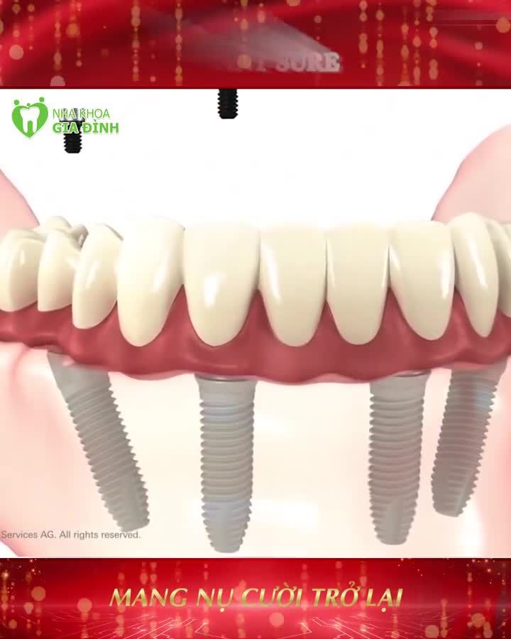 CẤY IMPLANT SURE - PHƯƠNG PHÁP  SIÊU TIẾT KIỆM KHẮC PHỤC MẤT RĂNG HIỆU QUẢ