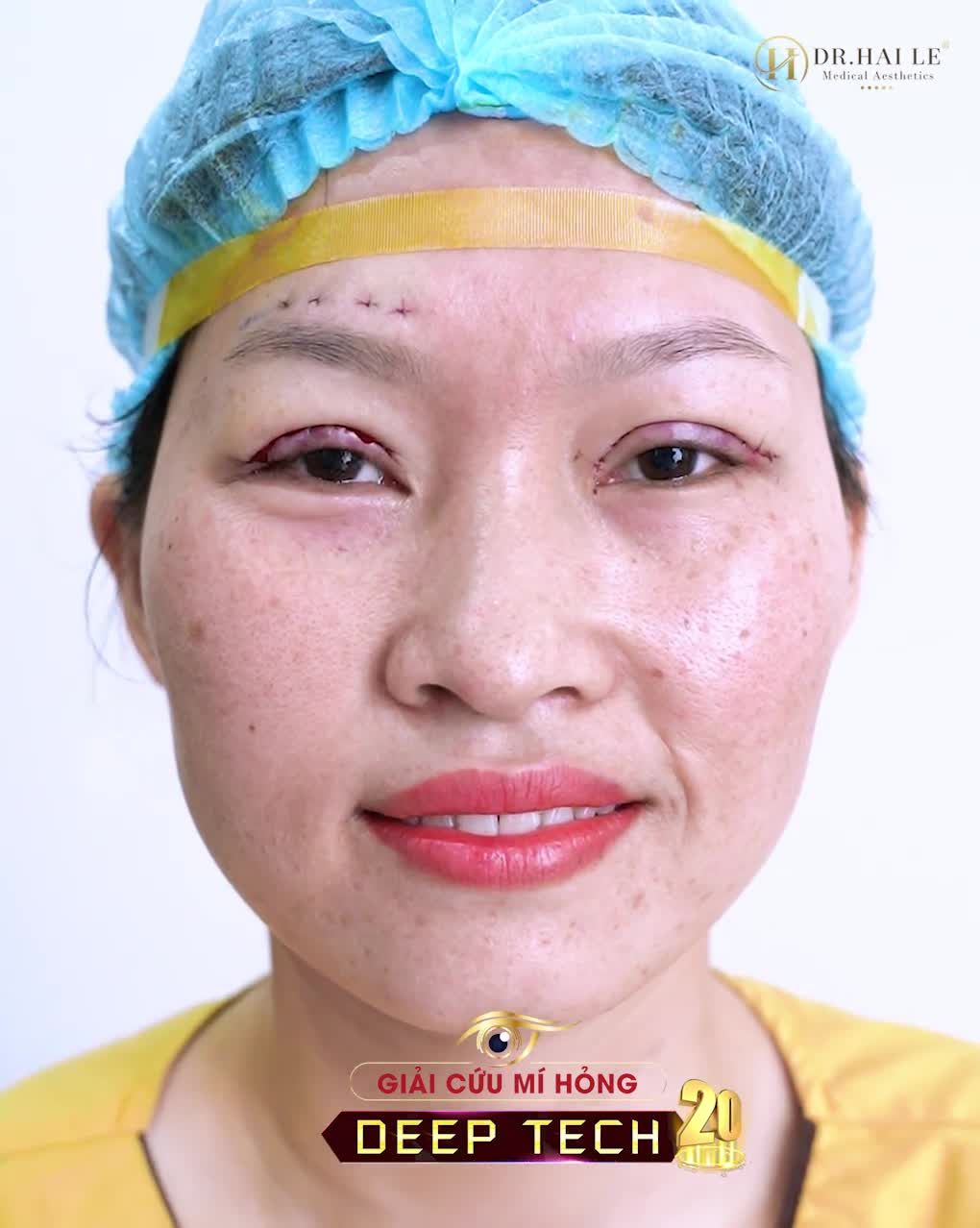 Chị đã thức tới 2h sáng chỉ để xem những video, hình ảnh sửa mí bên Dr.Hải Lê