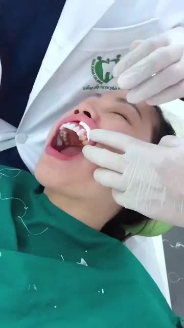 Chị Ngân đến với Nha khoa Gia Đình trong tình trạng: Răng ố vàng, răng thưa, sứt mẻ, hình thể răng không đẹp