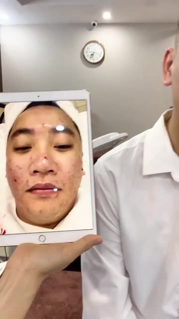 Chia sẻ chân thật từ khách hàng nam sau 5 buổi trị mụn Công nghệ De- Acne tại BVTM KANGNAM