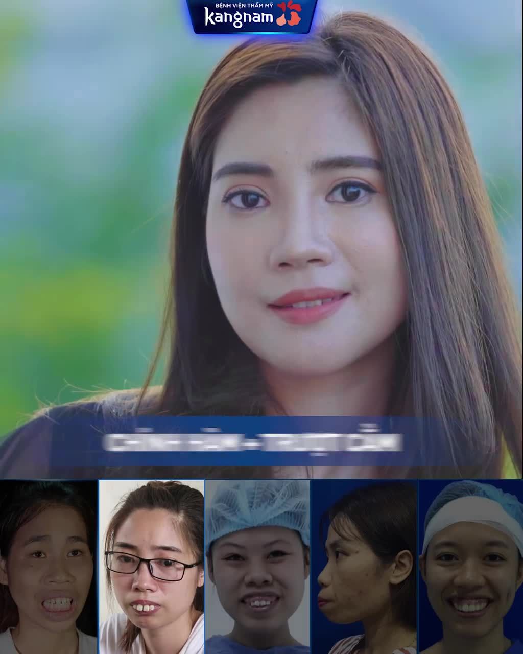 Chỉnh hàm hô "lột xác" như thế nào?
