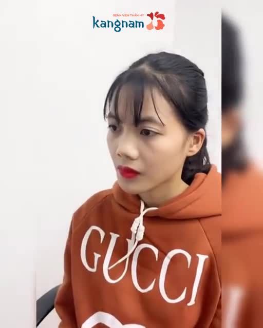 "Chỉnh hàm hô xong bạn không nhận ra em nữa" - 1 màn "lột xác" quá xuất sắc