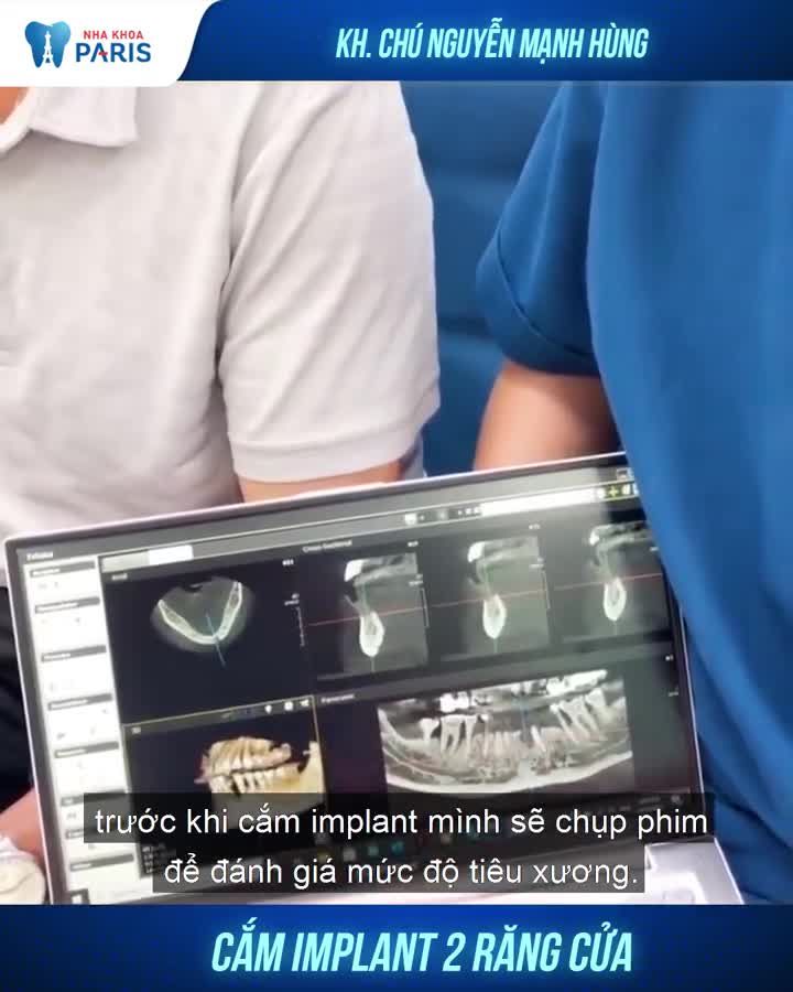 Chú Hùng sau cắm 2 trụ Implant cảm thấy thế nào?