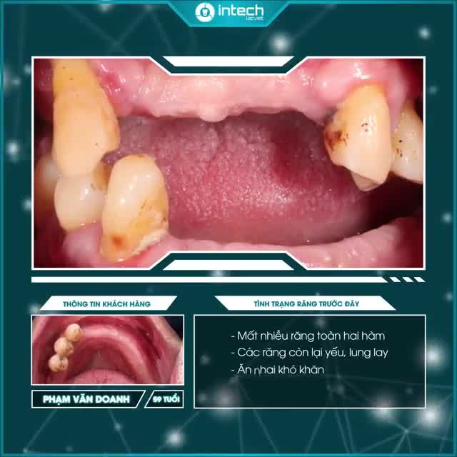 CHÚ PHẠM VĂN DOANH "ƯỚC GÌ TÔI BIẾT ĐẾN TRỒNG RĂNG IMPLANT SỚM HƠN"