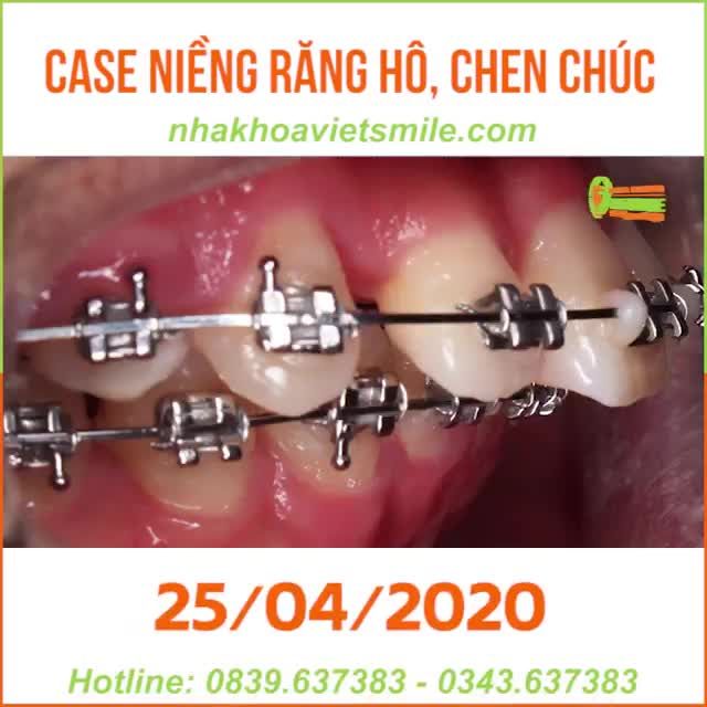 Có một sự thay đổi “không hề nhẹ” sau 2 năm niềng răng của bạn khách hàng tại Viet Smile.