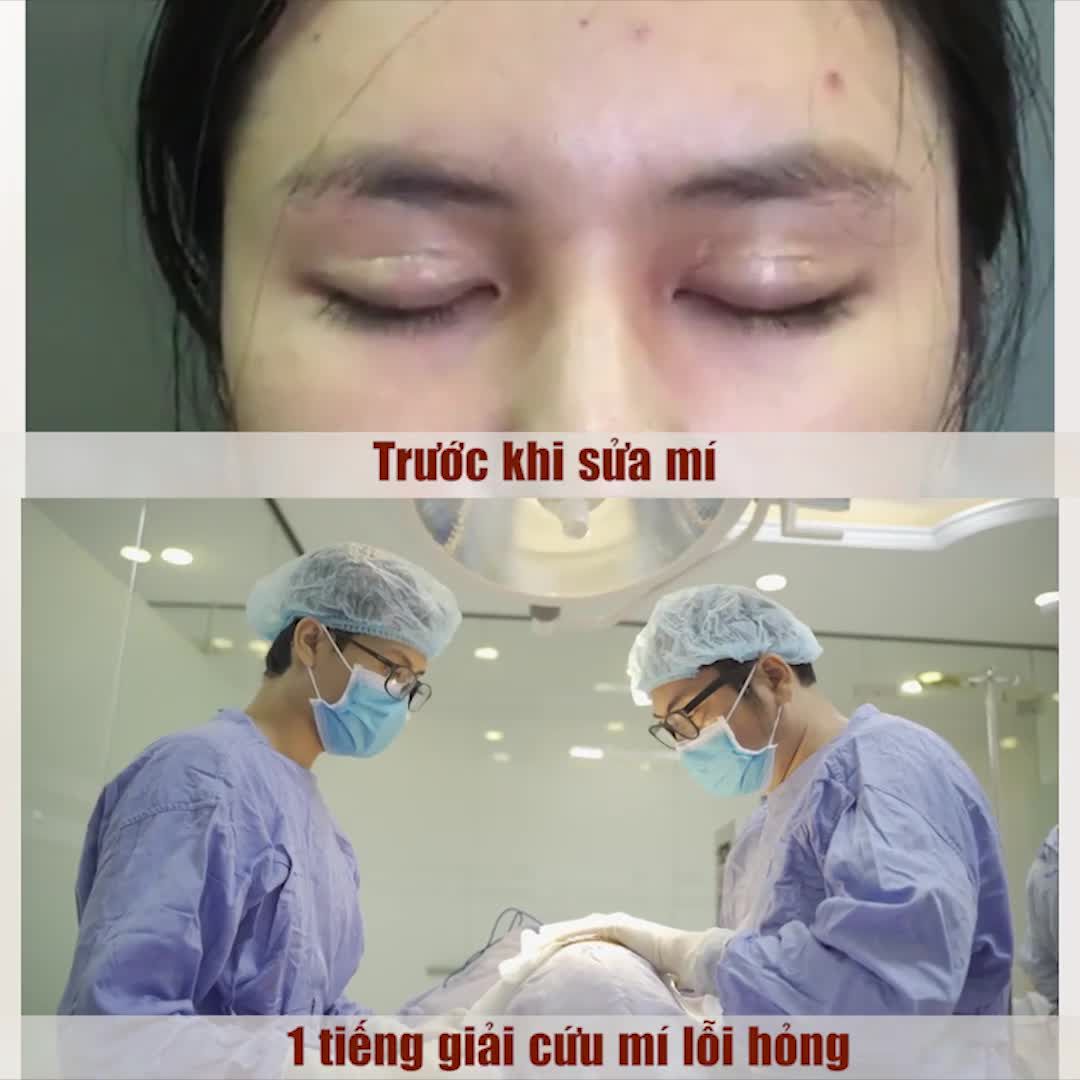 CƠ nâng mi đính sâu Nếp mí to, 2 mắt thiếu cân đối - Cường cơ nâng mi