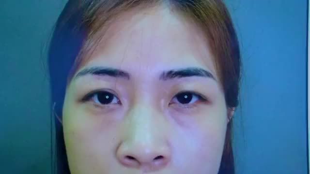 Combo Cắt mí trên + Cắt mí dưới vừa thực hiện xong đẹp rạng rỡ như thế nào