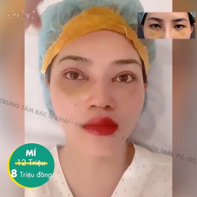 COMBO LÀM ĐẸP CHO ĐÔI MẮT 2 MÍ Cắt Mí + Mở Góc Mắt