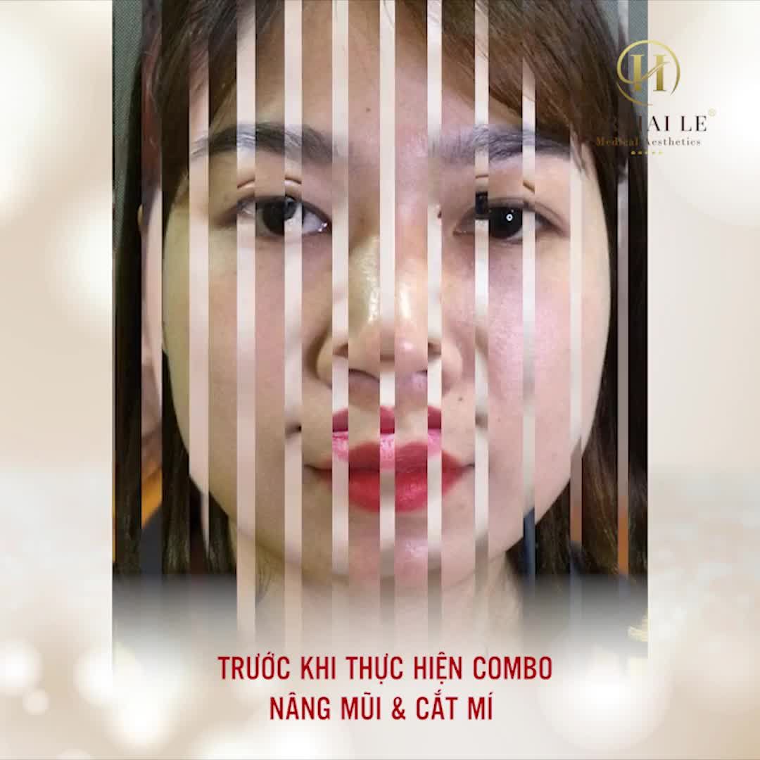 Combo Nâng mũi Cắt mí sau 10 ngày