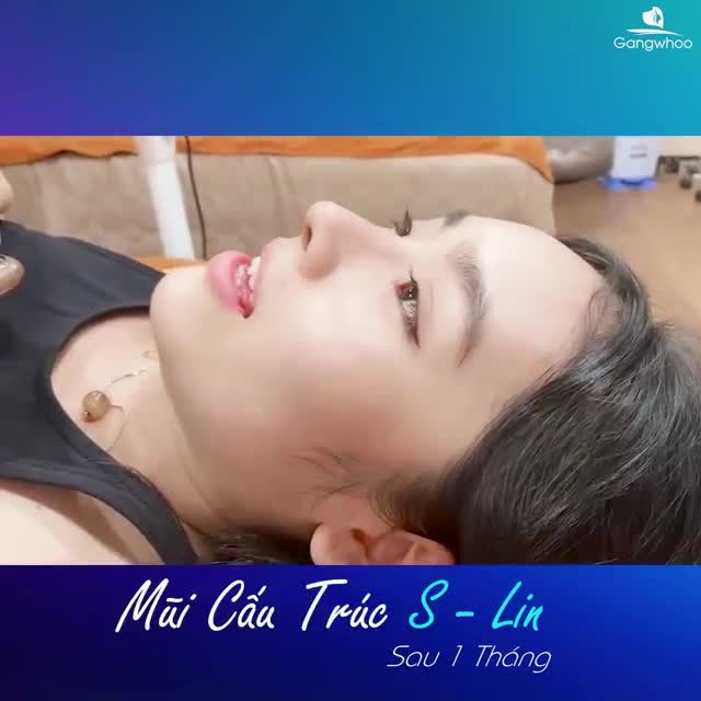 Cùng chiêm ngưỡng chiếc mũi sang trọng, thần thái của chị My sau khi Nâng mũi cấu trúc S-line được 1 tháng nhé!