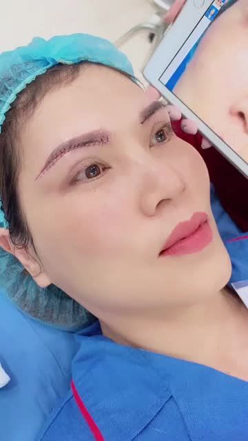 Cung mày xập xệ, lão hoa sớm, che nếp mí