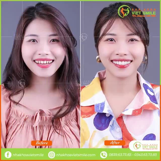 Cùng nghe những chia sẻ của khách hàng Ngọc Hoa sau khi trải nghiệm dịch vụ dán sứ Veneer 8 răng tại Nha khoa Việt Smile.