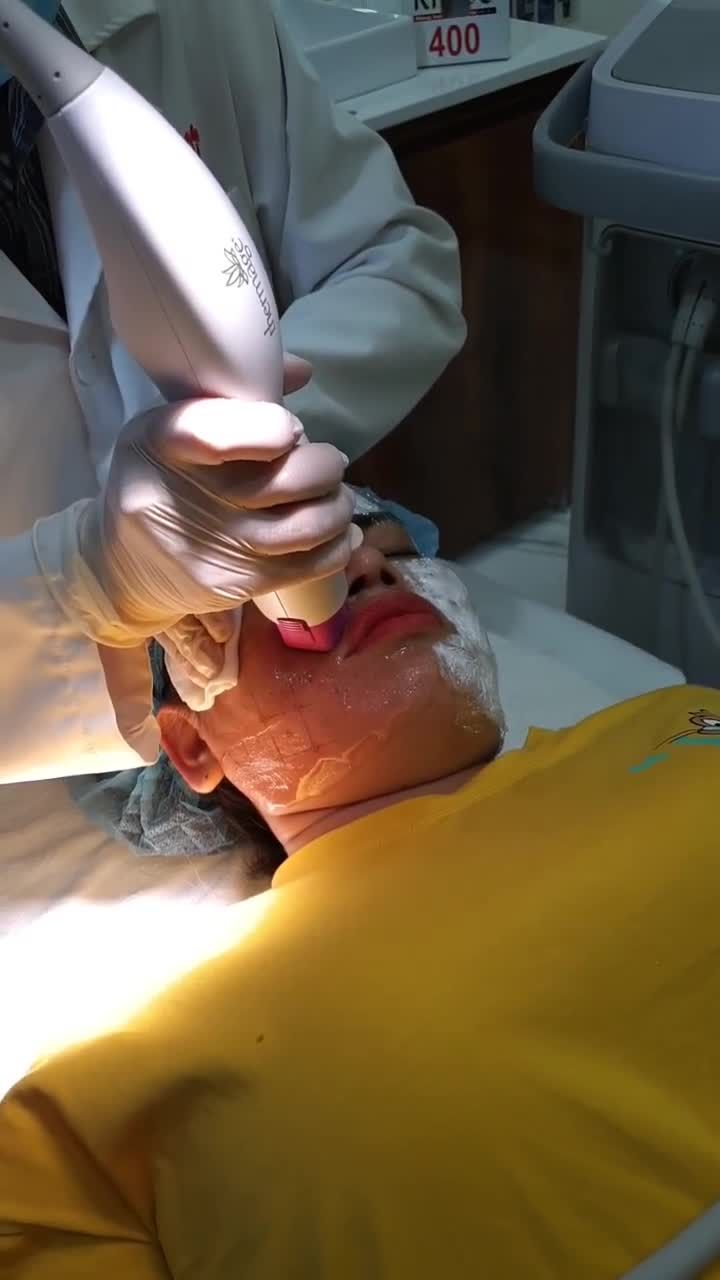 Da nhăn, rãnh má do lõa hóa - Muốn TRẺ HÓA không phẫu thuật