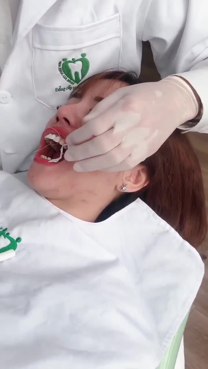 DÁN SỨ VENEER CAO CẤP  – MỪNG SINH NHẬT 16 TUỔI