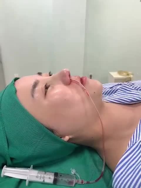 Dáng mũi thấp gãy, đầu mũi to, ngắn khiến khuôn mặt kém thanh thoát.
