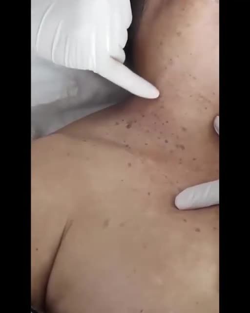Đánh bay MỤN THỊT chi chít vùng cổ trong "tích tắc" với Laser CO2 Fractional