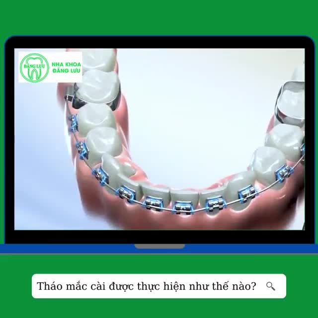 Đây chắc hẳn là giai đoạn mà các Niềng răng - er mong đợi nhất!