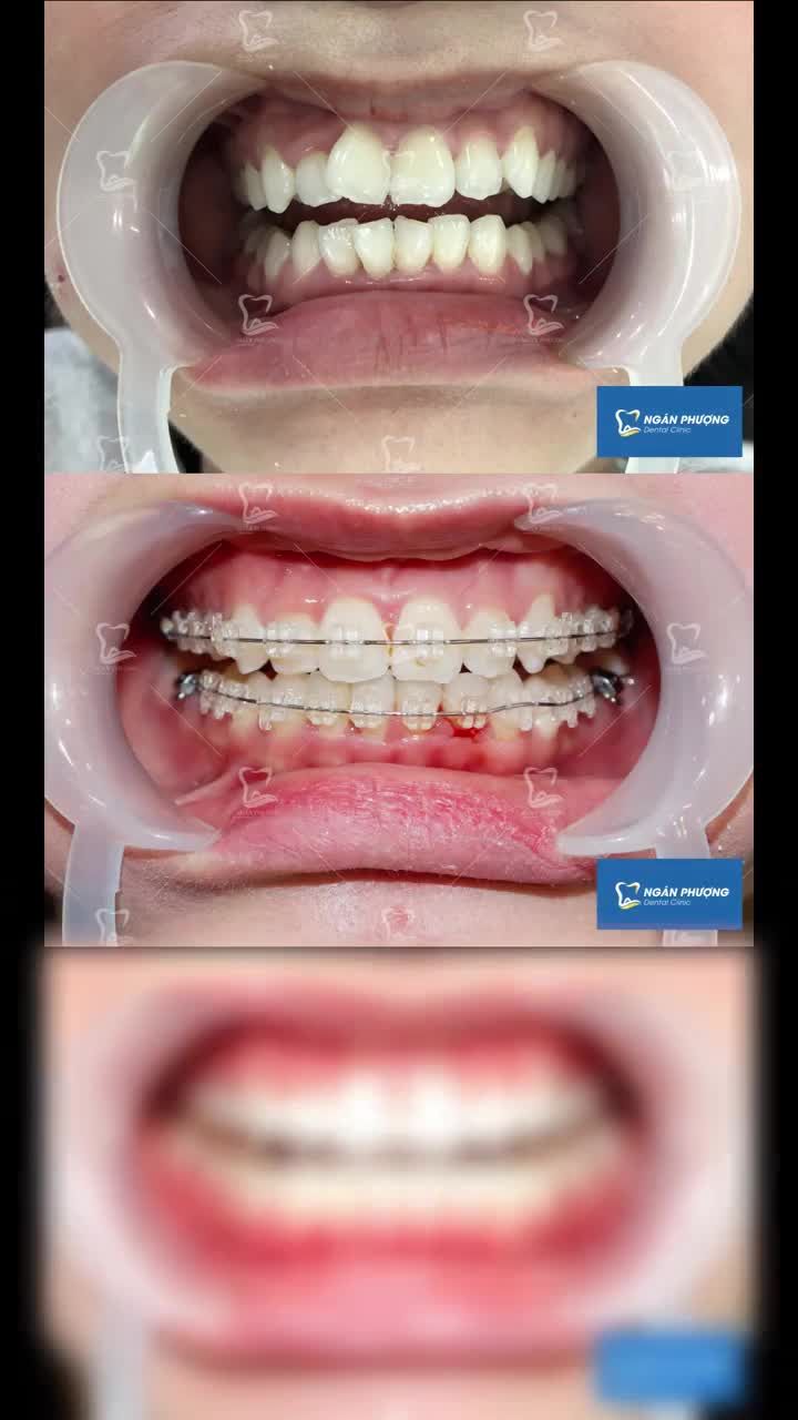 ĐỂ CÓ MỘT NỤ CƯỜI ĐẸP THÌ CẦN MỘT HÀM RĂNG ĐỀU ĐẸP
