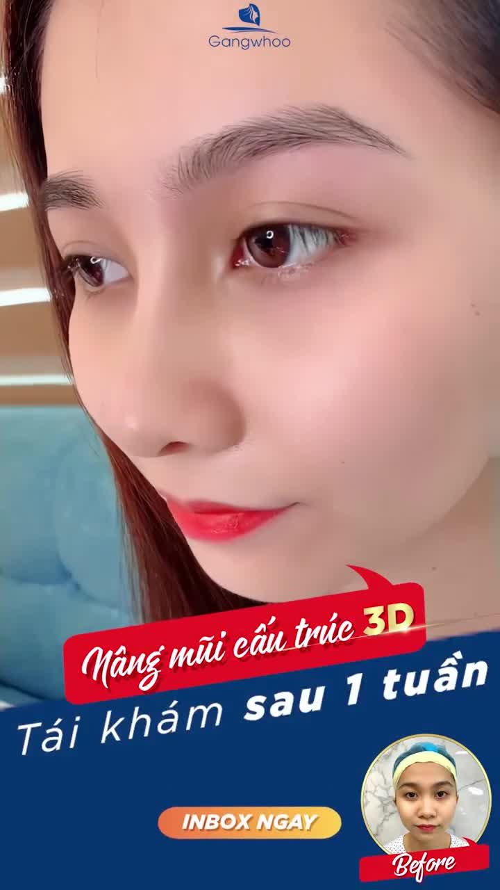 ĐẸP NHƯ MINH TINH SAU NÂNG MŨI CẤU TRÚC 3D