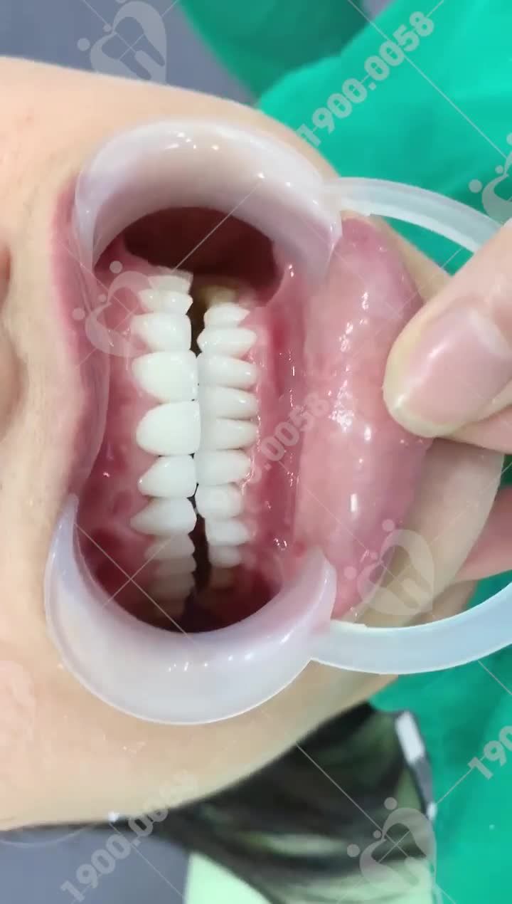 ĐI TÌM NỤ CƯỜI MỚI VỚI THẨM MỸ RĂNG TẠI NHA KHOA GIA ĐÌNH