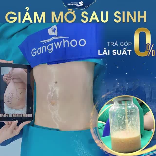 DỊCH VỤ “HÓT HÒN HỌT” HIỆN NAY – GIẢM MỠ SAU SINH LIPO ULTRASOUND