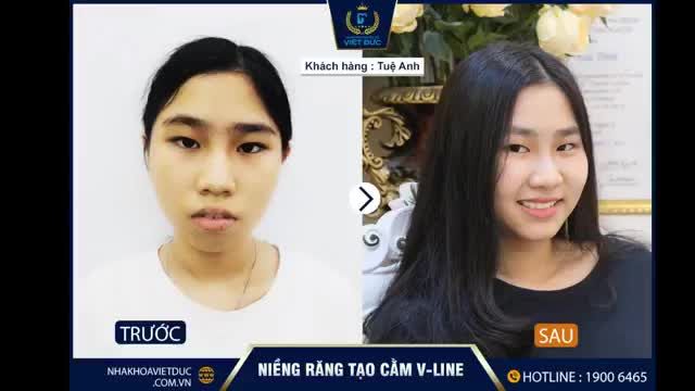 ĐIỀU GÌ KHIẾN CON GÁI HỌA SĨ NGUYỄN QUỐC HUY QUYẾT ĐỊNH LỰA CHỌN NHA KHOA QUỐC TẾ VIỆT ĐỨC TÌM LẠI NỤ CƯỜI RẠNG RỠ.